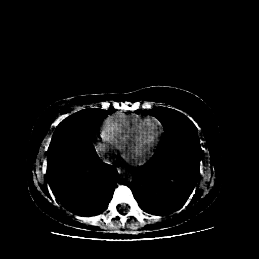Reconstructed NATIVE CT scan (cycle consistency)