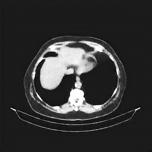 Reconstructed NATIVE CT scan (cycle consistency)