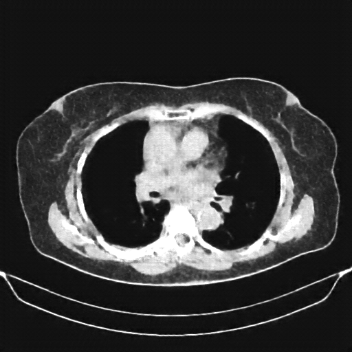 Reconstructed NATIVE CT scan (cycle consistency)