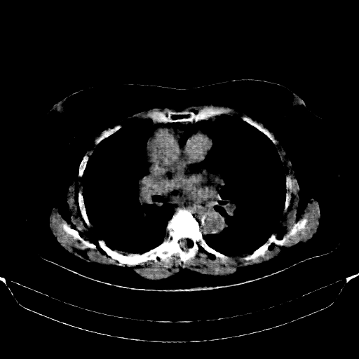 Reconstructed NATIVE CT scan (cycle consistency)