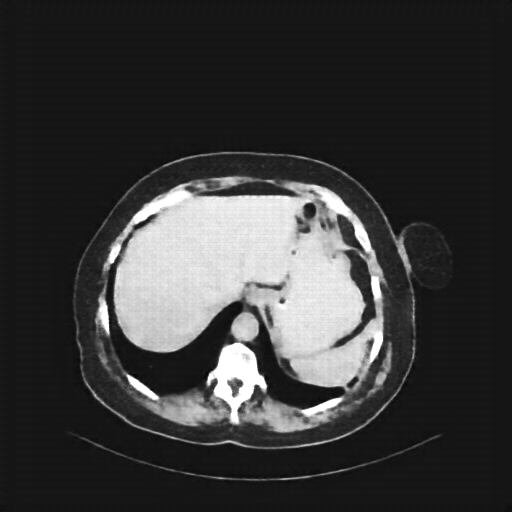 Reconstructed NATIVE CT scan (cycle consistency)