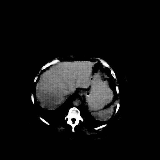 Reconstructed NATIVE CT scan (cycle consistency)