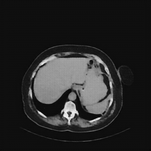 Reconstructed NATIVE CT scan (cycle consistency)
