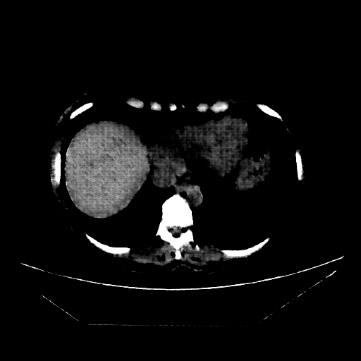 Reconstructed NATIVE CT scan (cycle consistency)