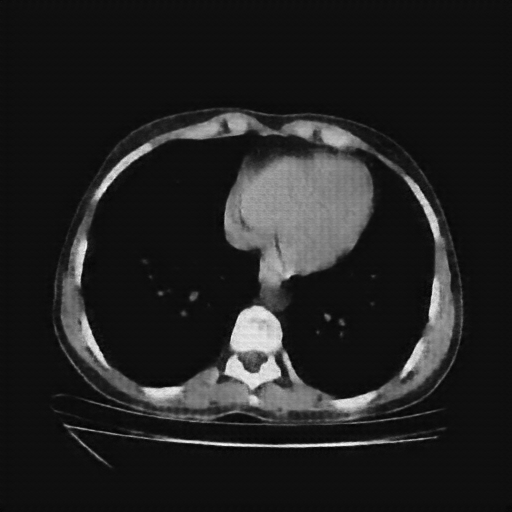 Reconstructed NATIVE CT scan (cycle consistency)