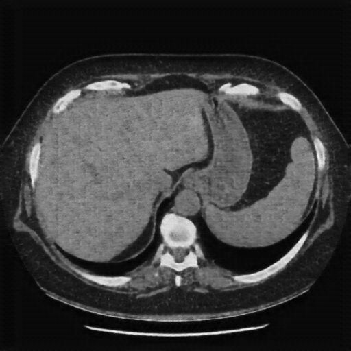 Generated VENOUS CT scan (A→B translation)