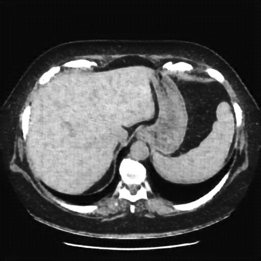 Reconstructed NATIVE CT scan (cycle consistency)