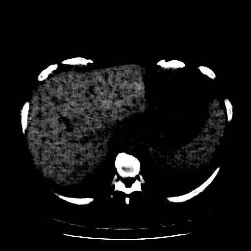 Reconstructed NATIVE CT scan (cycle consistency)