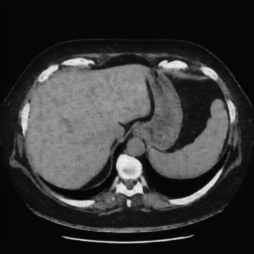 Reconstructed NATIVE CT scan (cycle consistency)