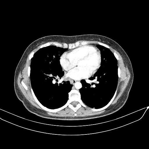 Original VENOUS CT scan