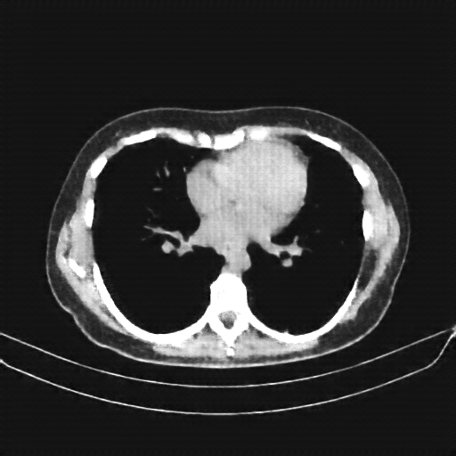 Reconstructed NATIVE CT scan (cycle consistency)