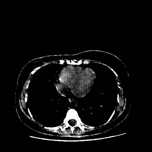 Generated VENOUS CT scan (A→B translation)