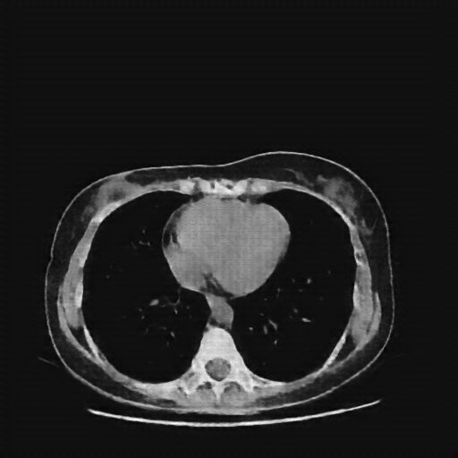 Reconstructed NATIVE CT scan (cycle consistency)