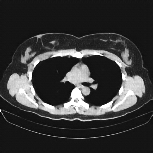 Reconstructed NATIVE CT scan (cycle consistency)