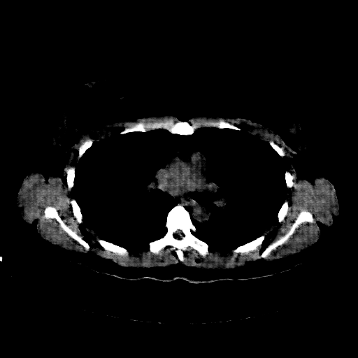 Reconstructed NATIVE CT scan (cycle consistency)