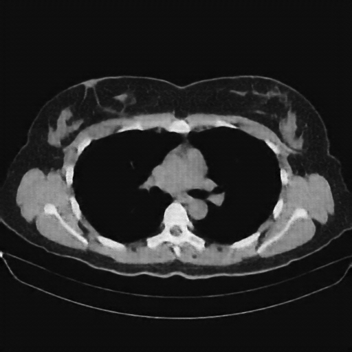 Reconstructed NATIVE CT scan (cycle consistency)