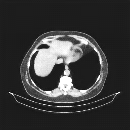 Generated VENOUS CT scan (A→B translation)