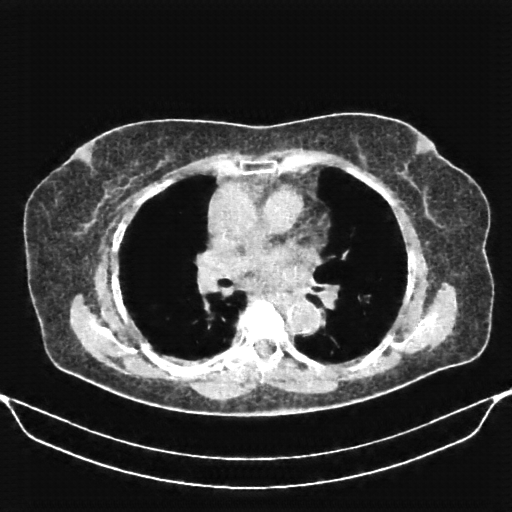 Generated VENOUS CT scan (A→B translation)