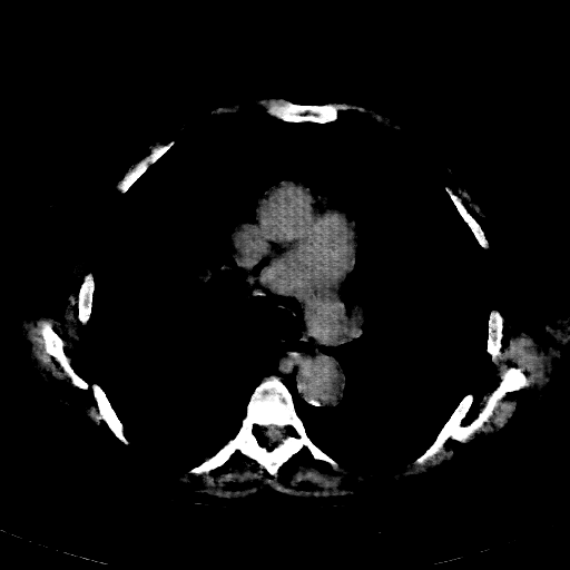 Reconstructed NATIVE CT scan (cycle consistency)