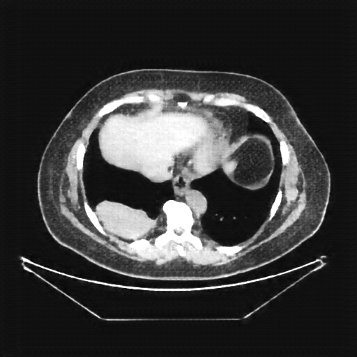Generated VENOUS CT scan (A→B translation)
