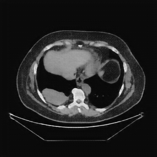 Generated VENOUS CT scan (A→B translation)