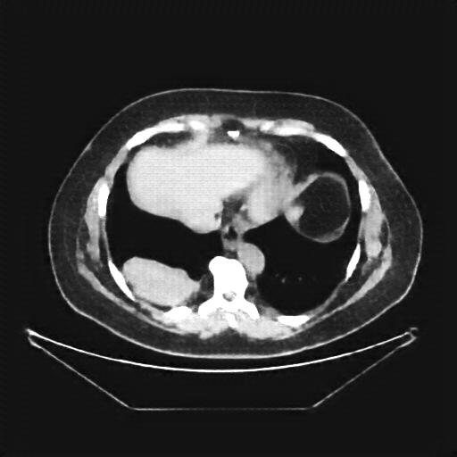 Reconstructed NATIVE CT scan (cycle consistency)