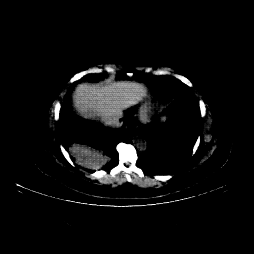 Reconstructed NATIVE CT scan (cycle consistency)