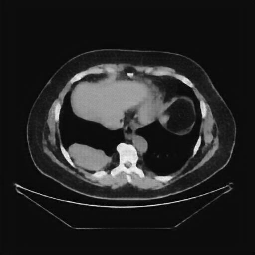 Reconstructed NATIVE CT scan (cycle consistency)