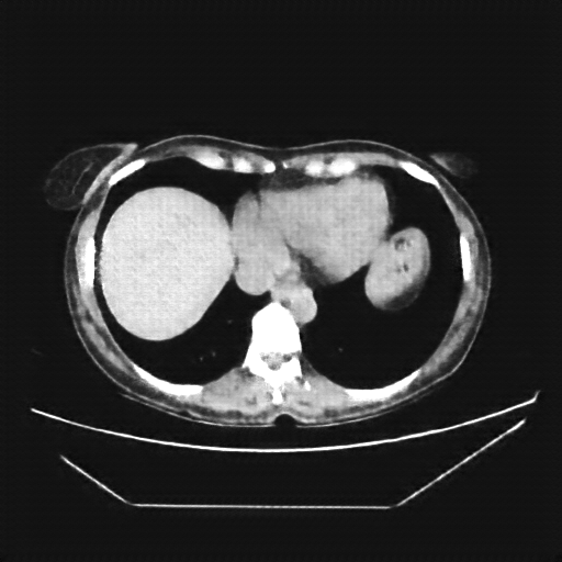 Reconstructed NATIVE CT scan (cycle consistency)