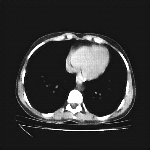 Reconstructed NATIVE CT scan (cycle consistency)