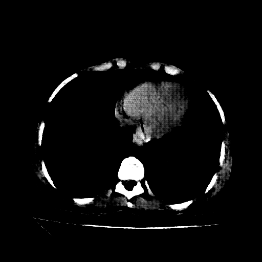 Reconstructed NATIVE CT scan (cycle consistency)