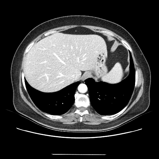 Original VENOUS CT scan
