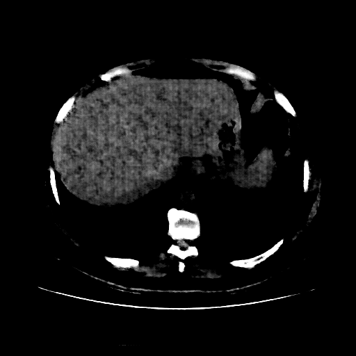 Reconstructed NATIVE CT scan (cycle consistency)