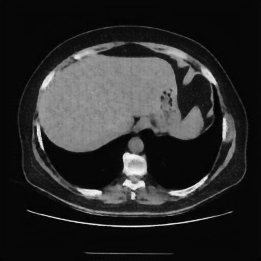 Reconstructed NATIVE CT scan (cycle consistency)