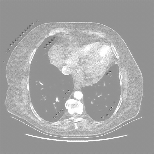 Reconstructed NATIVE CT scan (cycle consistency)