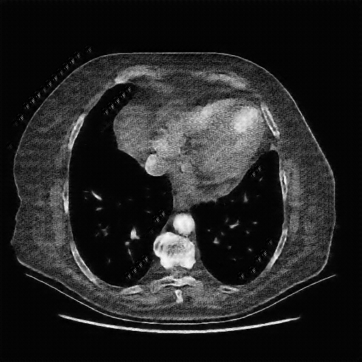 Reconstructed NATIVE CT scan (cycle consistency)