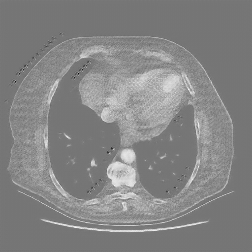 Reconstructed NATIVE CT scan (cycle consistency)
