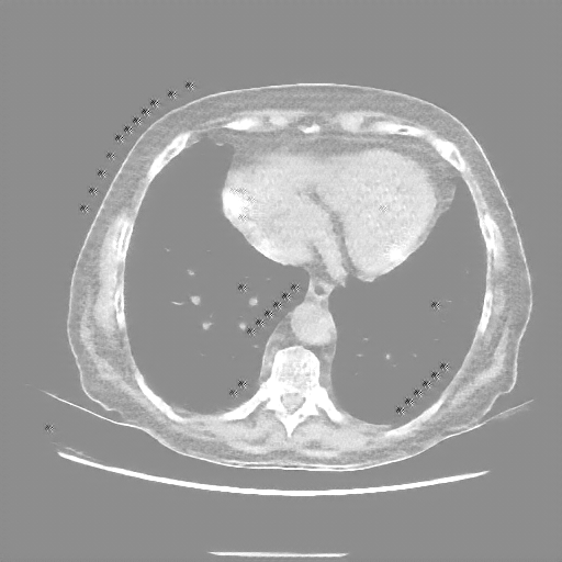 Reconstructed NATIVE CT scan (cycle consistency)