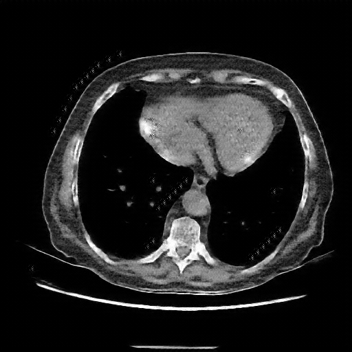 Reconstructed NATIVE CT scan (cycle consistency)