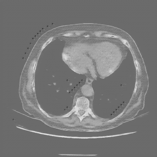 Reconstructed NATIVE CT scan (cycle consistency)