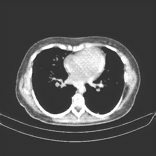 Generated VENOUS CT scan (A→B translation)