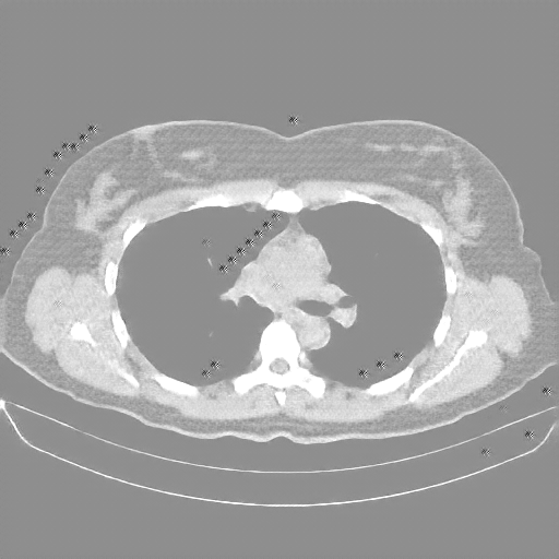 Reconstructed NATIVE CT scan (cycle consistency)