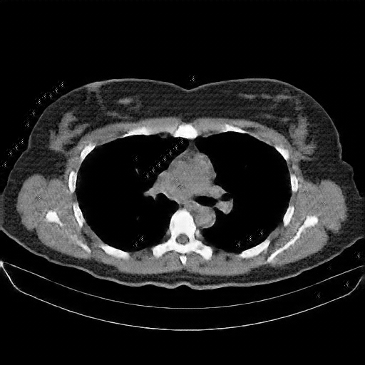 Reconstructed NATIVE CT scan (cycle consistency)