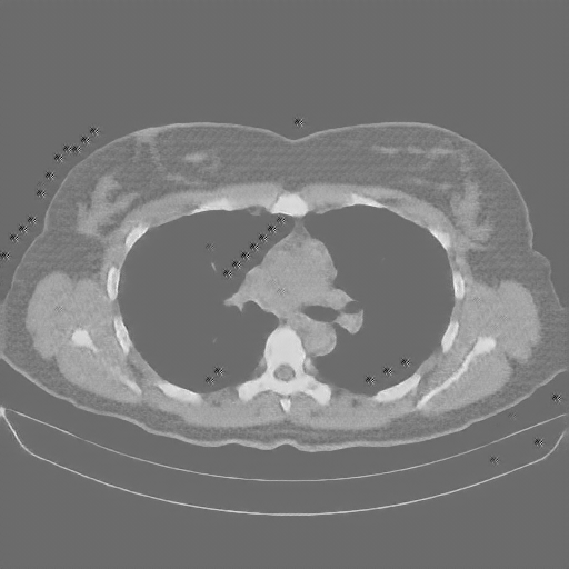 Reconstructed NATIVE CT scan (cycle consistency)