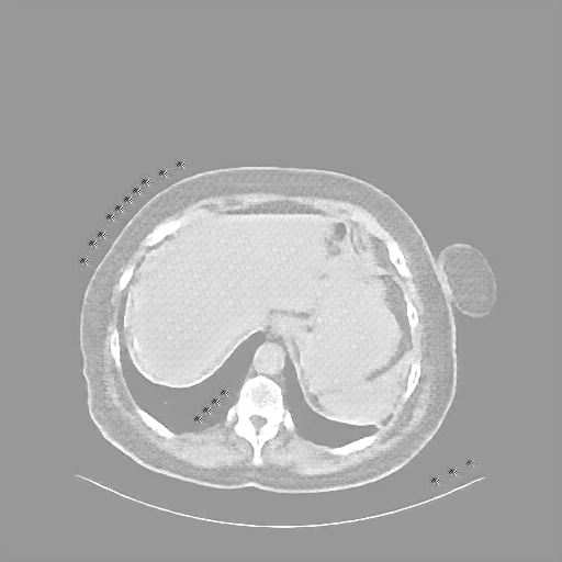 Reconstructed NATIVE CT scan (cycle consistency)