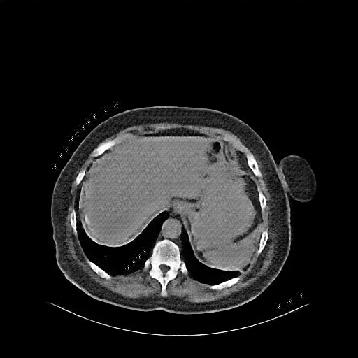 Reconstructed NATIVE CT scan (cycle consistency)