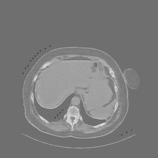 Reconstructed NATIVE CT scan (cycle consistency)