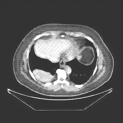 Generated VENOUS CT scan (A→B translation)
