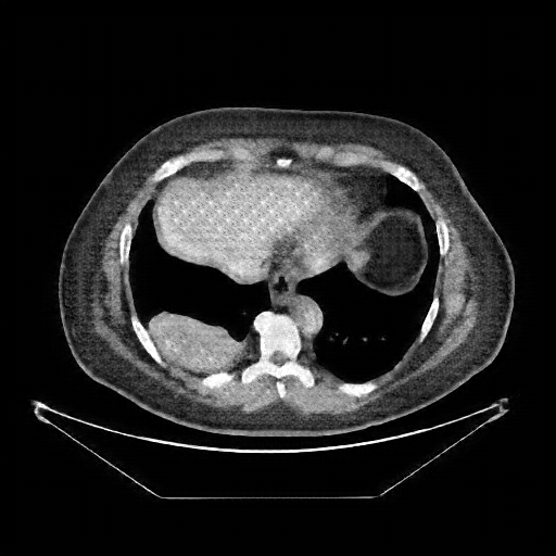 Generated VENOUS CT scan (A→B translation)