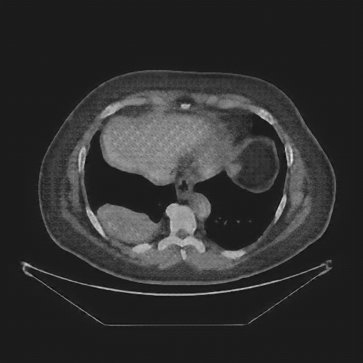 Generated VENOUS CT scan (A→B translation)